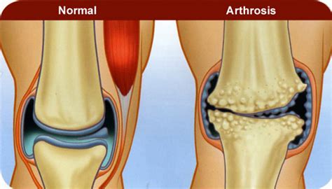 sağ kps artroz artriti nasıl tedavi edilir